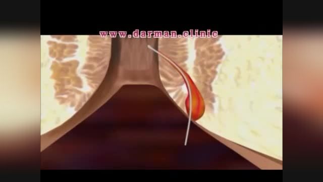درمان فیستول با لیزر - درمان کلینیک