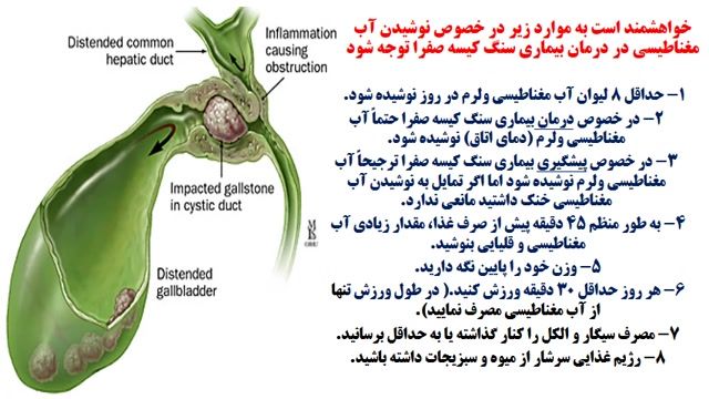 پیشگیری و درمان سنگ کیسه صفرا