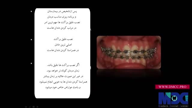 فیلم نصب براکت ارتودنسی|کلینیک دندانپزشکی مدرن