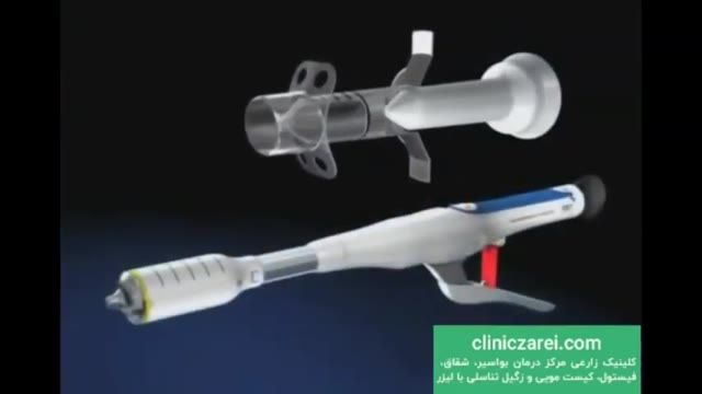 روش های درمان فیستول با لیزر بدون بازگشت و مراقبت های بعد از عمل در کلینیک زارعی
