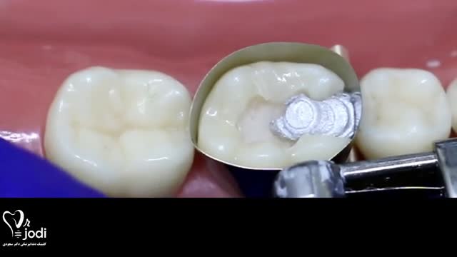 پرکردن دندان با مواد سفید خوبه یا سیاه