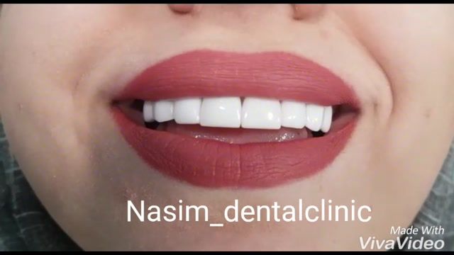 ارتودنسی لمینت ایمپلنت ونیرکامپوزیت اصلاح طرح لبخند کاشت دندان 