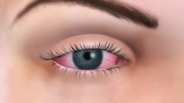 درمان خانگی خشکی چشم – علت – علائم و پیشگیری