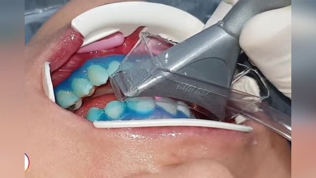 فیلم توضیحات بلیچینگ دندان با لیزر از زبان دکتر سجودی