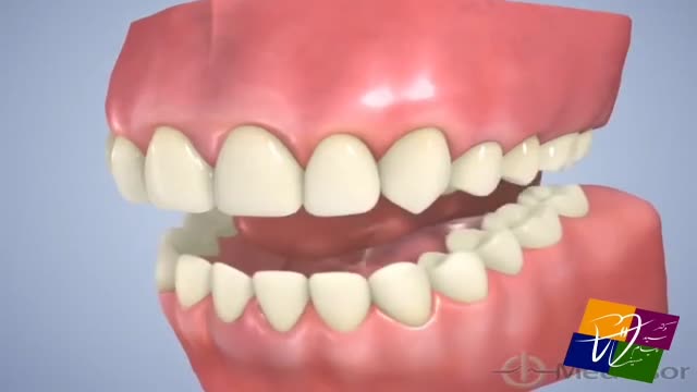 الاینر فنری ها جهت درمان نامنظمی های کوچک دندان های جلویی یا قدامی