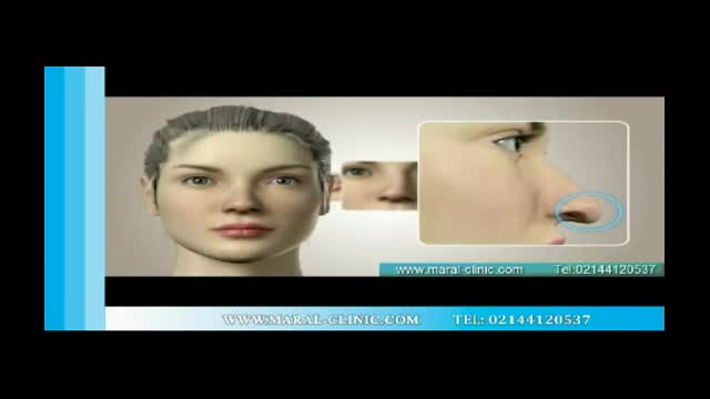 جراحی بینی | فیلم جراحی بینی | کلینیک پوست و مو مارال | شماره 1