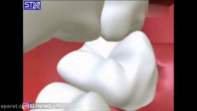 روند پوسیدگی دندان چگونه است؟